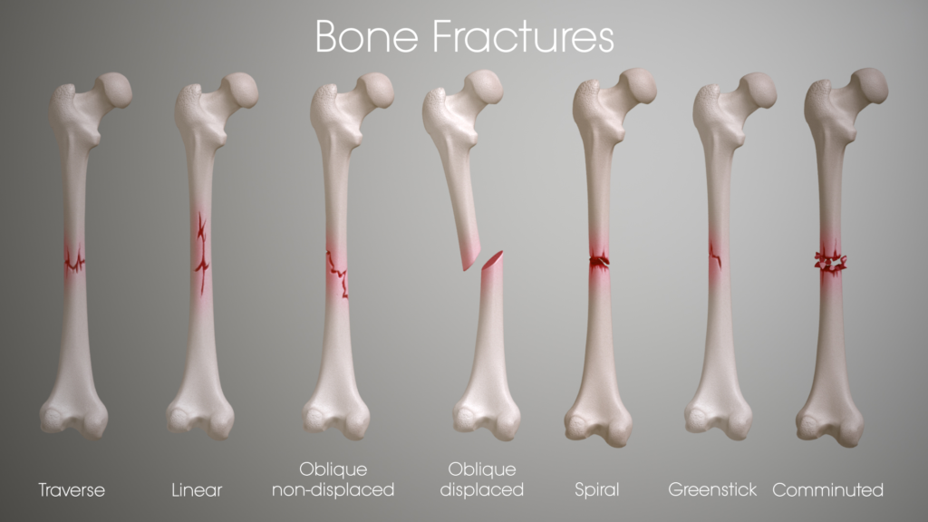 2. Fractures - Orthopedic Injuries