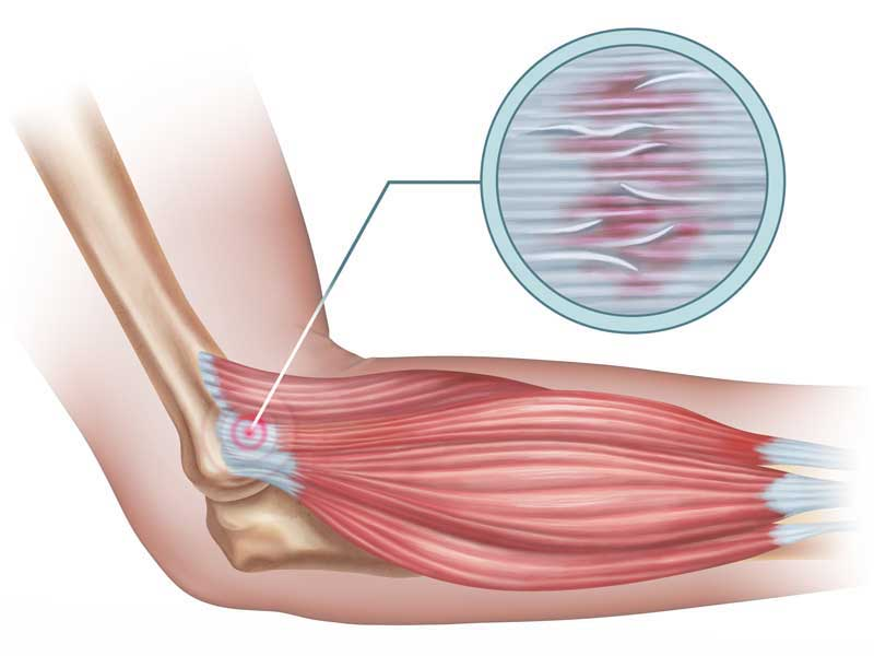 6. Tennis Elbow (Lateral Epicondylitis) - Orthopedic Injuries