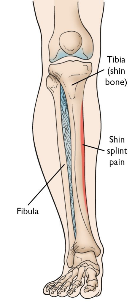 Shin Splints - Orthopedic Injuries 
