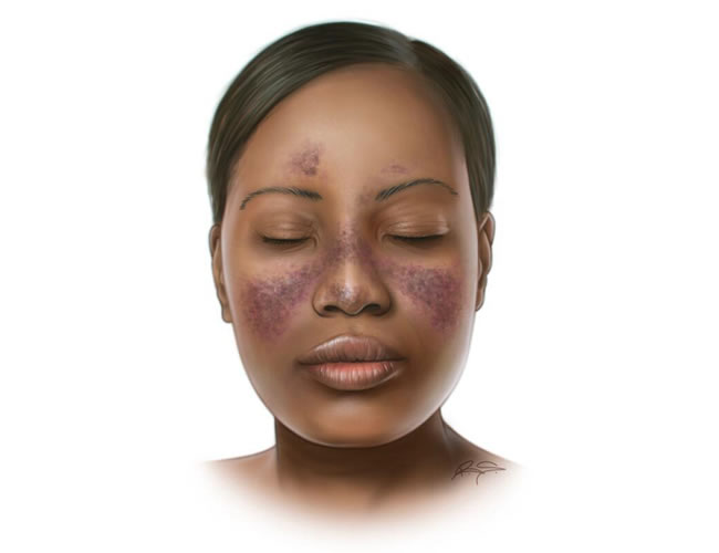 6. Lupus: Understanding the Autoimmune Skin Condition - Common Skin Conditions and Treatments