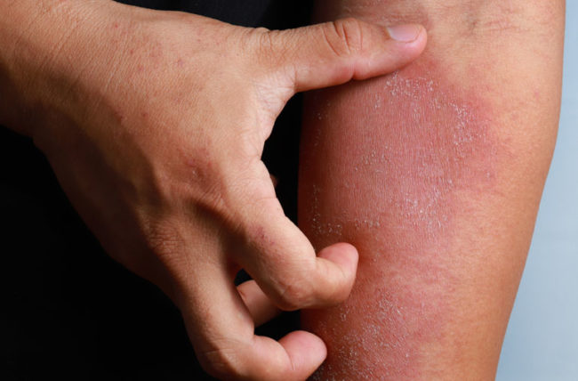 2. Eczema: Taming the Itch and Dryness - Common Skin Conditions and Treatments