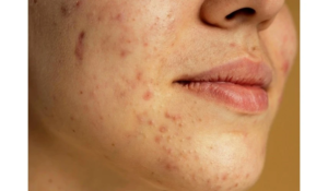 Acne #01 Common Skin Conditions 