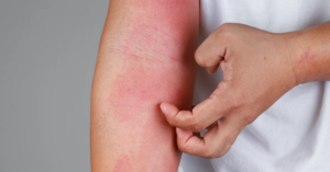 Eczema (Atopic Dermatitis) #02 Common Skin Conditions: 