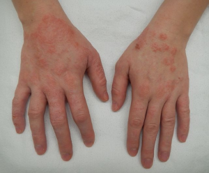 Dermatitis #05 Common Skin Conditions