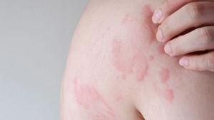 Hives (Urticaria)#06 Common Skin Conditions