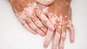 Vitiligo #07 Common Skin Conditions: