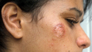 Impetigo #08 Common Skin Conditions