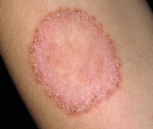 Ringworm #09 Common Skin Conditions