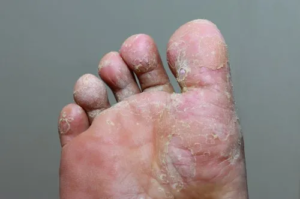 Athlete’s Foot #10 Common Skin Conditions