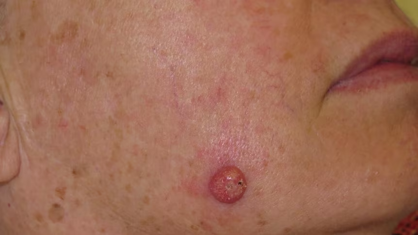 Red or flesh colored moles - A symptom of Skin Cancer