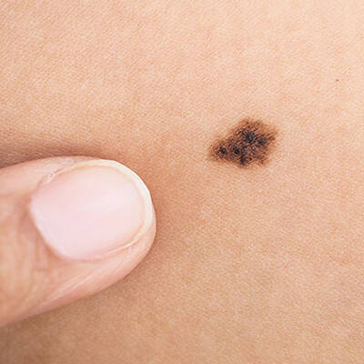Changes in Existing Skin Spots - A symptom of skin cancer