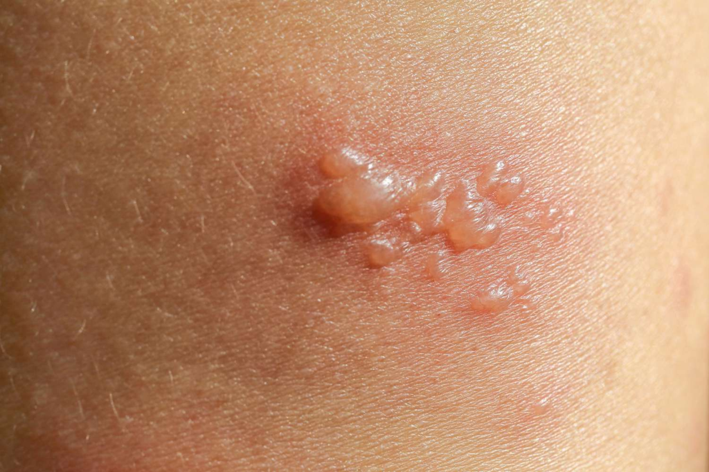 Sores - A symptom of Skin Cancer 